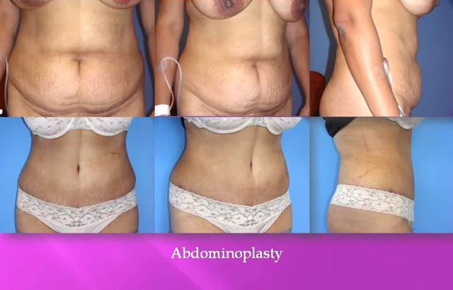 Tummy Tuck result at CK Plastic Surgery in Los Angeles, CA