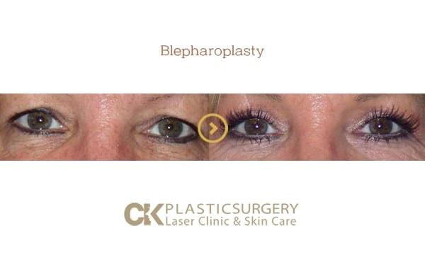 CK Plastic Surgery eyelid lift result — Los Angeles, CA
