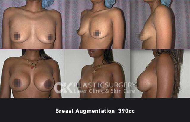Fat Transfer Breast Augmentation result at CK Plastic Surgery in Los Angeles, CA