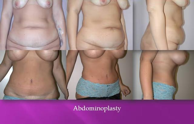 Tummy Tuck result at CK Plastic Surgery in Los Angeles, CA
