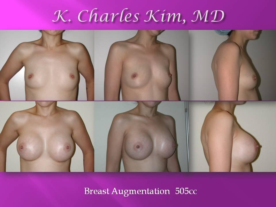 CK Plastic Surgery breast augmentation result — Los Angeles, CA