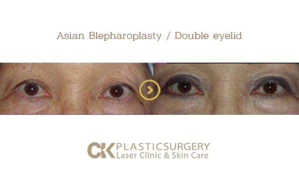 CK Plastic Surgery eyelid lift result — Los Angeles, CA