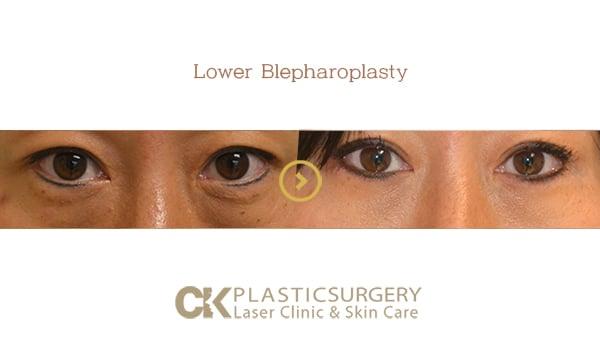 CK Plastic Surgery blepharoplasty result — Los Angeles, CA