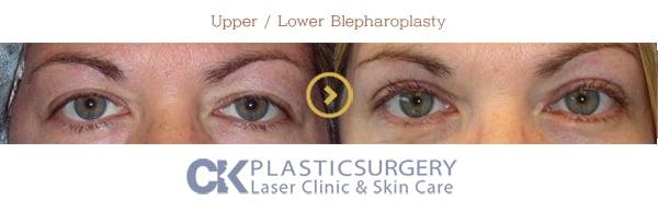 Blepharoplasty result at CK Plastic Surgery in Los Angeles, CA
