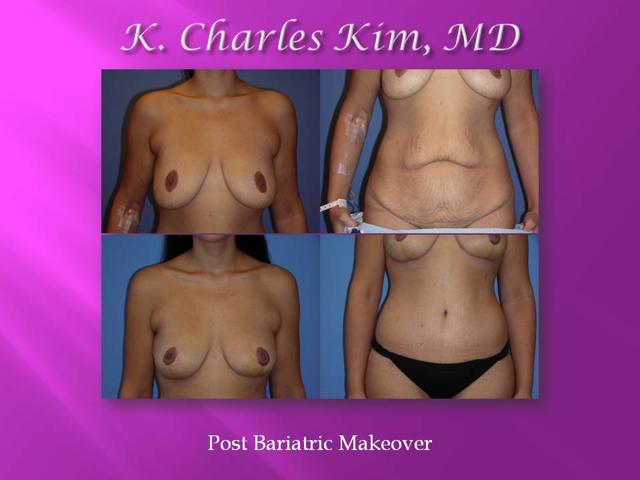 Breast Lift result at CK Plastic Surgery in Los Angeles, CA