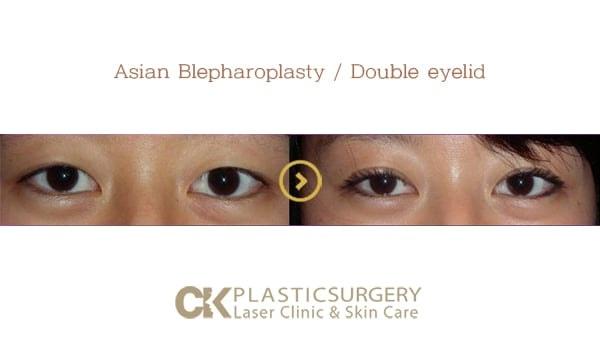 CK Plastic Surgery eyelid lift result — Los Angeles, CA