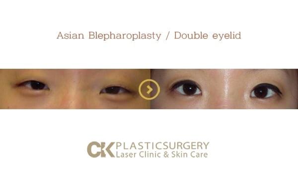 CK Plastic Surgery eyelid lift result — Los Angeles, CA