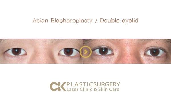 CK Plastic Surgery eyelid lift result — Los Angeles, CA