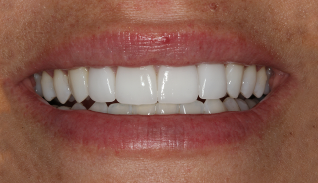 Smile Makeover after at Thomas Dental in Salt Lake City, UT