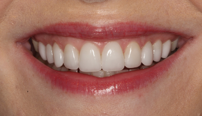 Thomas Dental smile makeover after — Salt Lake City, UT