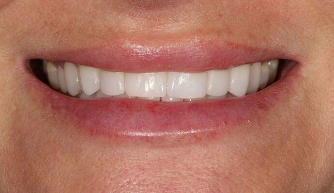 Thomas Dental smile makeover after — Salt Lake City, UT