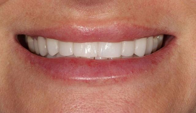 Smile Makeover after at Thomas Dental in Salt Lake City, UT