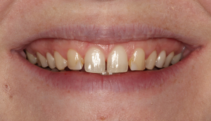 Smile Makeover before