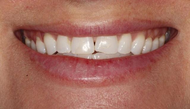 Smile Makeover before at Thomas Dental in Salt Lake City, UT