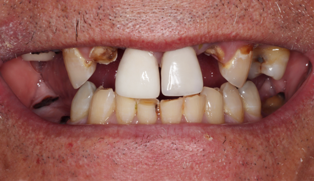 Dental Implants before at Thomas Dental in Salt Lake City, UT