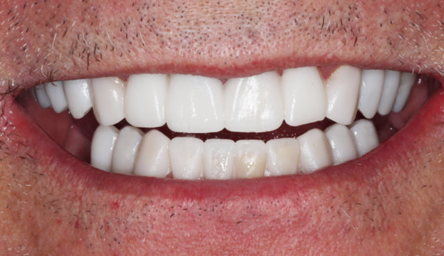 Dental Implants after at Thomas Dental in Salt Lake City, UT