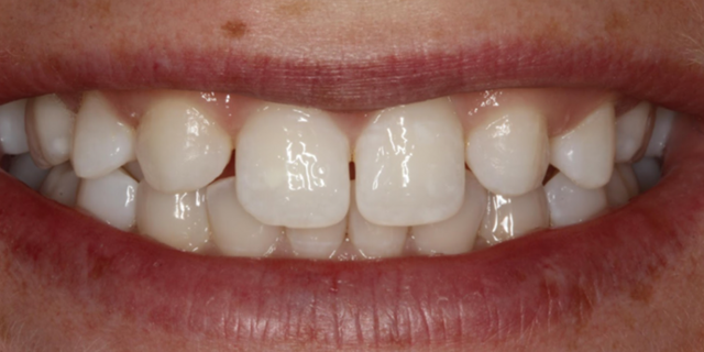 Smile Makeover before at Thomas Dental in Salt Lake City, UT