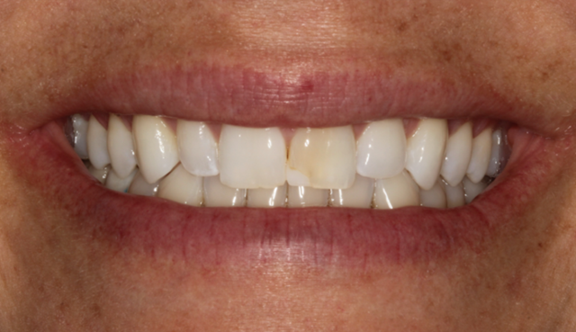 Smile Makeover before at Thomas Dental in Salt Lake City, UT