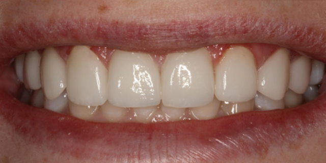 Smile Makeover after at Thomas Dental in Salt Lake City, UT