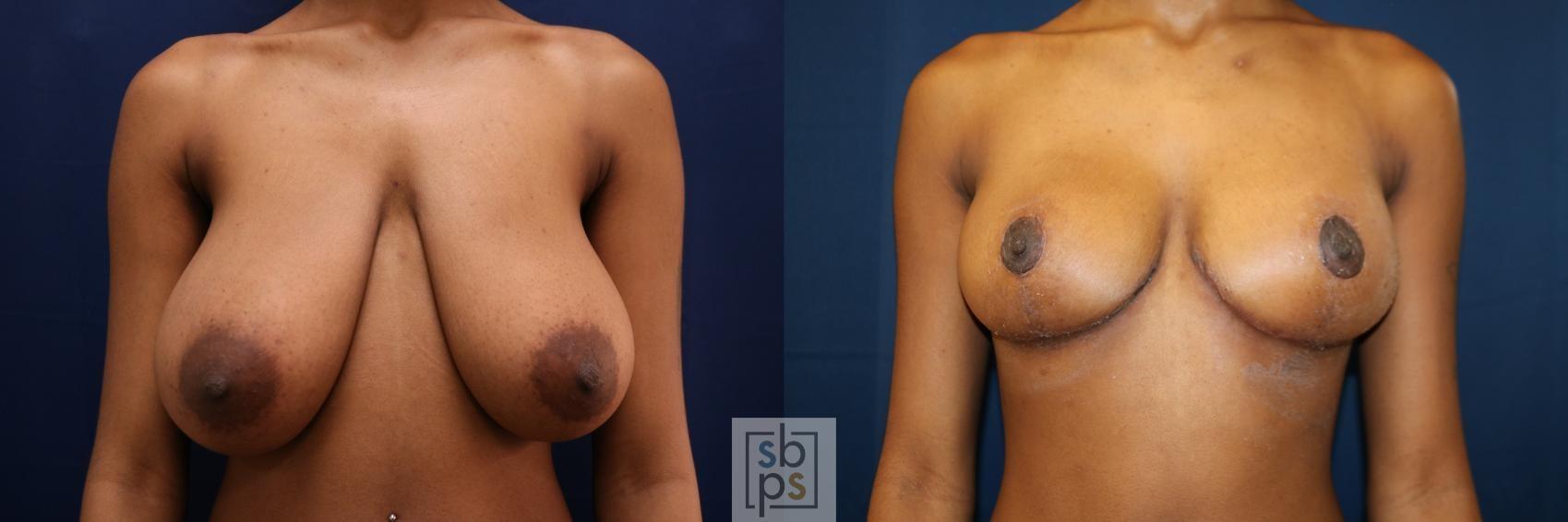 South Bay Plastic Surgeons breast reduction result — Torrance, CA