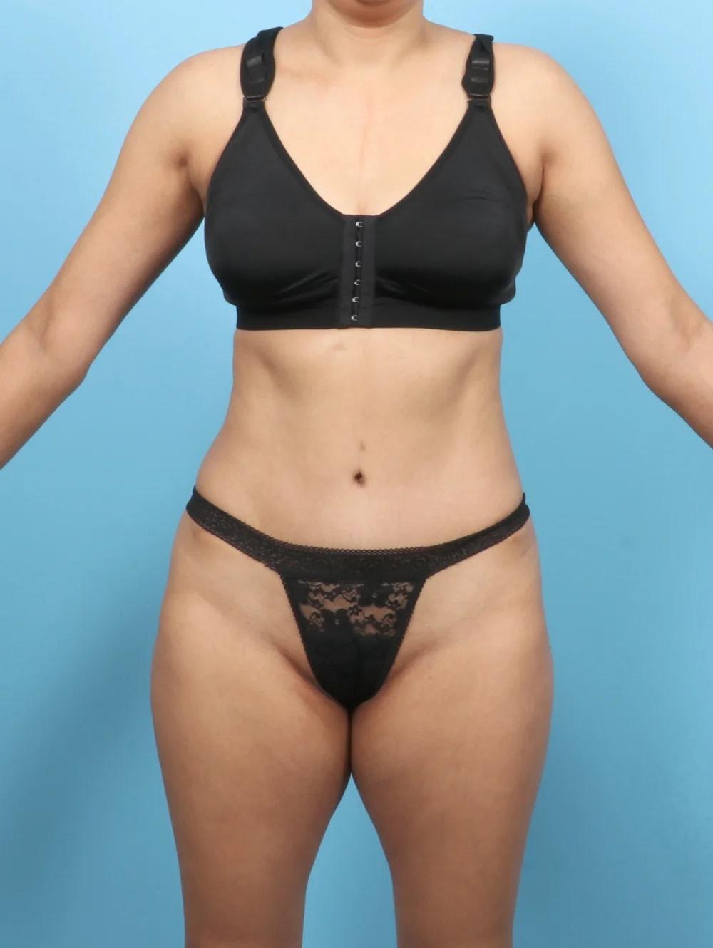 Lauren Daly, MD tummy tuck after — Folsom, CA