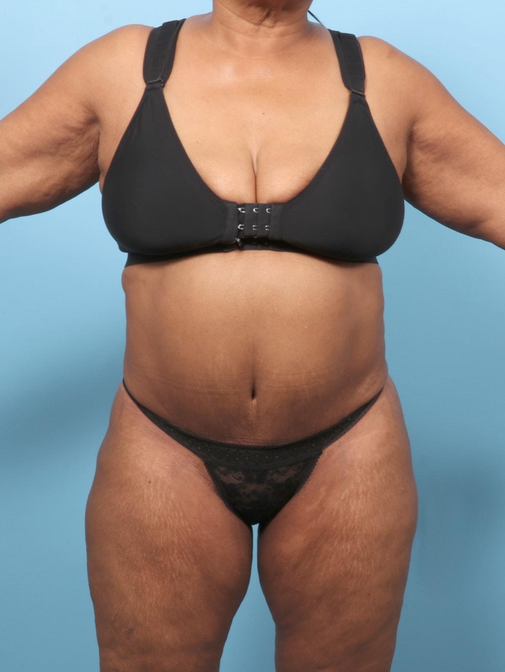 Lauren Daly, MD tummy tuck after — Folsom, CA