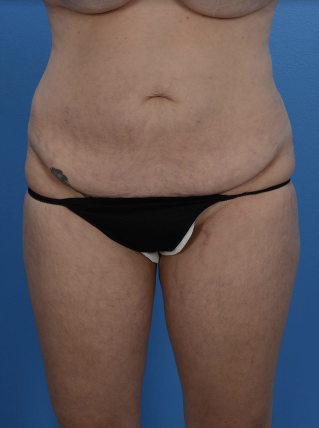Tummy Tuck before at Plastic Surgery Specialists of Boca Raton in Boca Raton, FL