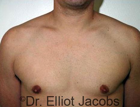 Plastic Surgery Specialists of Boca Raton gynecomastia after — Boca Raton, FL
