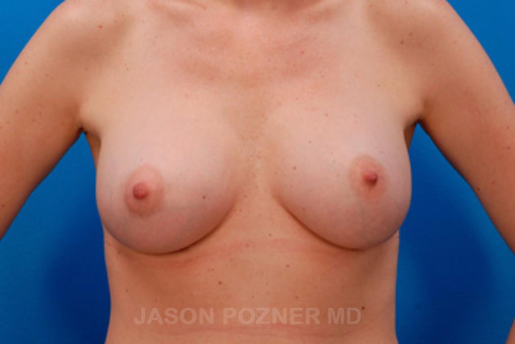Plastic Surgery Specialists of Boca Raton breast augmentation after — Boca Raton, FL