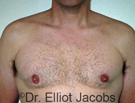 Plastic Surgery Specialists of Boca Raton gynecomastia after — Boca Raton, FL