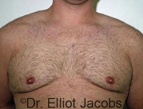 Plastic Surgery Specialists of Boca Raton gynecomastia after — Boca Raton, FL