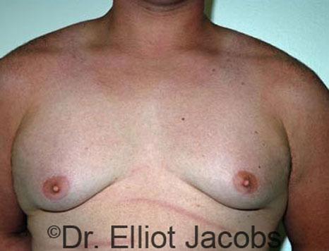 Gynecomastia Surgery before at Plastic Surgery Specialists of Boca Raton in Boca Raton, FL