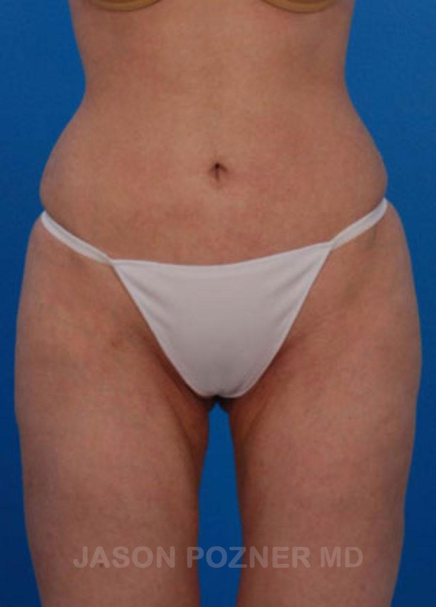Plastic Surgery Specialists of Boca Raton liposuction after — Boca Raton, FL