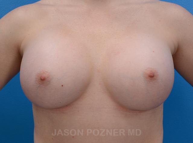Breast Augmentation after at Plastic Surgery Specialists of Boca Raton in Boca Raton, FL