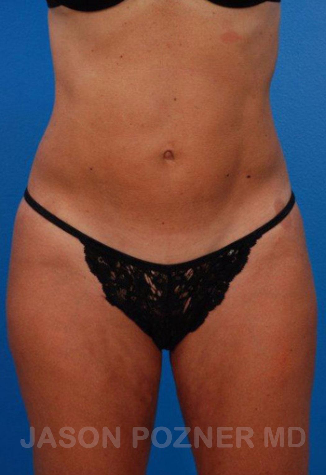 Plastic Surgery Specialists of Boca Raton liposuction after — Boca Raton, FL