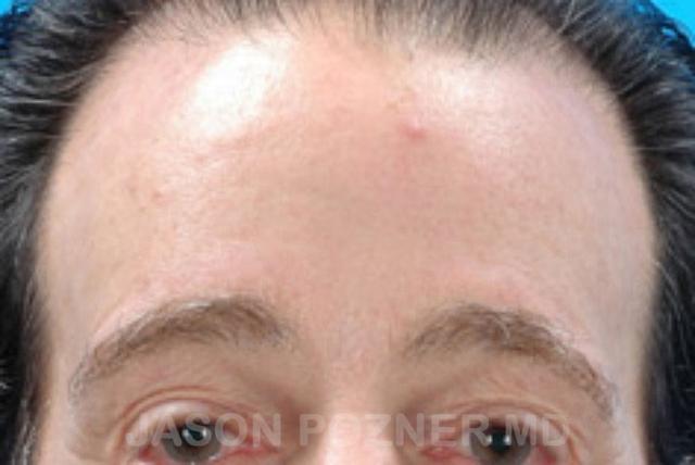 Brow Lift after at Plastic Surgery Specialists of Boca Raton in Boca Raton, FL