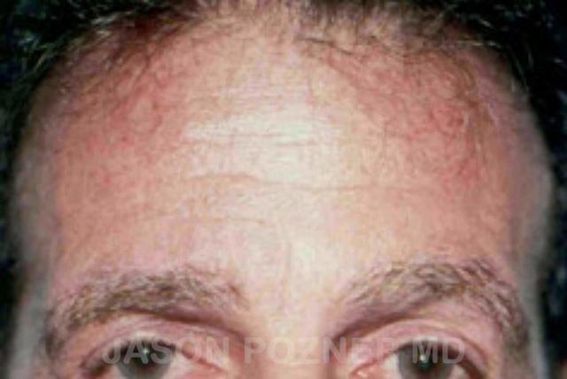 Brow Lift before at Plastic Surgery Specialists of Boca Raton in Boca Raton, FL