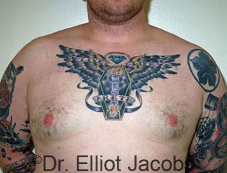 Plastic Surgery Specialists of Boca Raton gynecomastia after — Boca Raton, FL