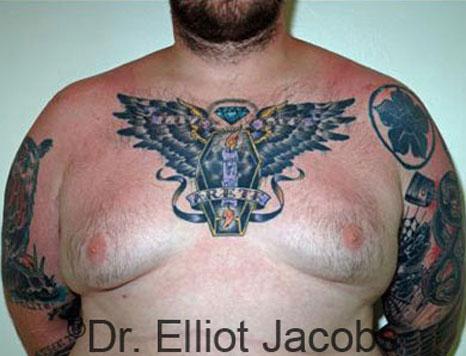 Gynecomastia Surgery before at Plastic Surgery Specialists of Boca Raton in Boca Raton, FL
