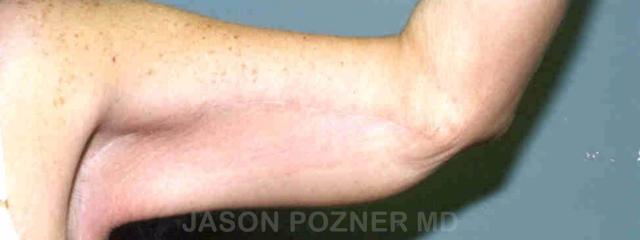 CoolSculpting after at Plastic Surgery Specialists of Boca Raton in Boca Raton, FL