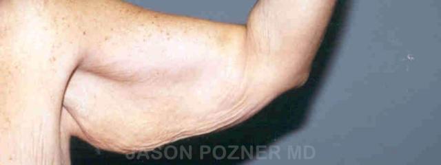 CoolSculpting before at Plastic Surgery Specialists of Boca Raton in Boca Raton, FL