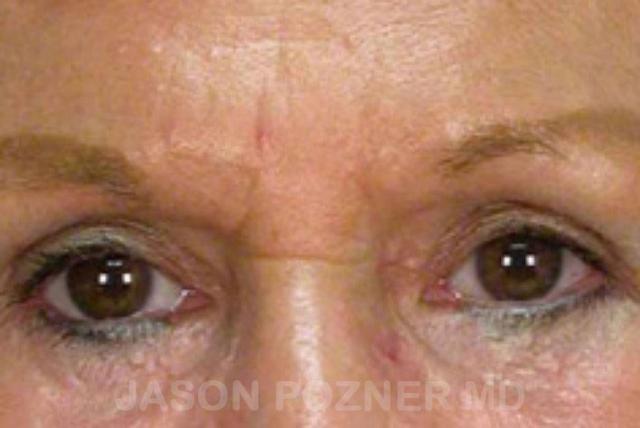 Brow Lift after at Plastic Surgery Specialists of Boca Raton in Boca Raton, FL