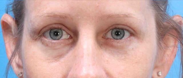 Blepharoplasty after at Plastic Surgery Specialists of Boca Raton in Boca Raton, FL