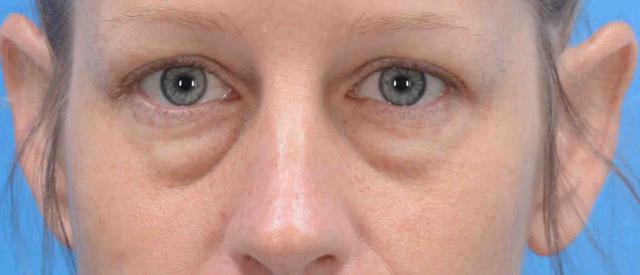 Blepharoplasty before at Plastic Surgery Specialists of Boca Raton in Boca Raton, FL