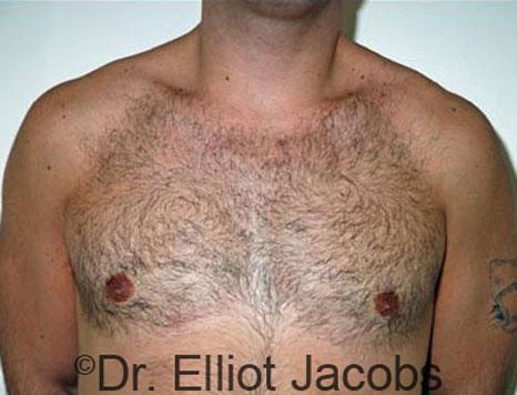 Plastic Surgery Specialists of Boca Raton gynecomastia after — Boca Raton, FL