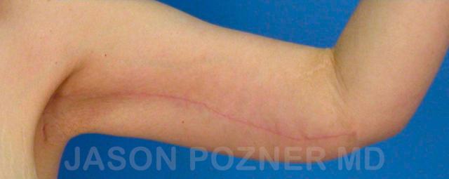 Arm Lift after at Plastic Surgery Specialists of Boca Raton in Boca Raton, FL