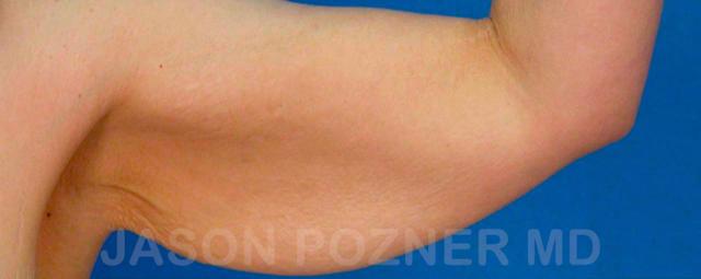 Arm Lift before at Plastic Surgery Specialists of Boca Raton in Boca Raton, FL