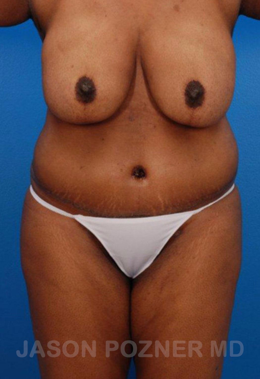 Plastic Surgery Specialists of Boca Raton liposuction after — Boca Raton, FL