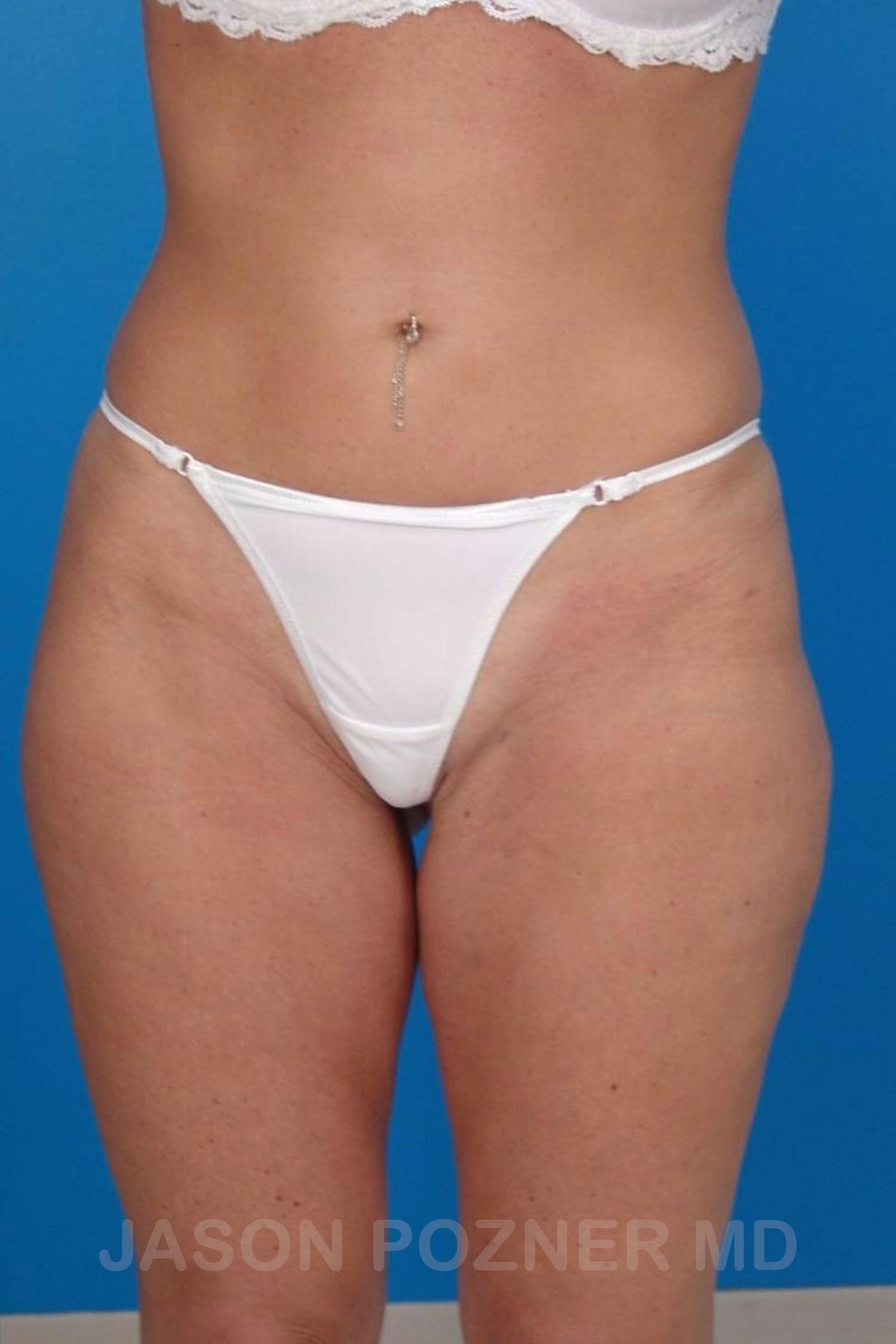 Plastic Surgery Specialists of Boca Raton liposuction after — Boca Raton, FL