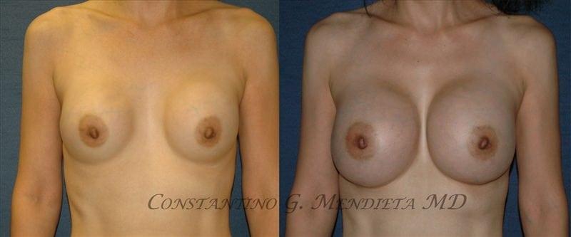 4 Beauty Aesthetics Institute for Plastic Surgery: Dr. Constantino Mendieta breast augmentation revision result — Miami, FL